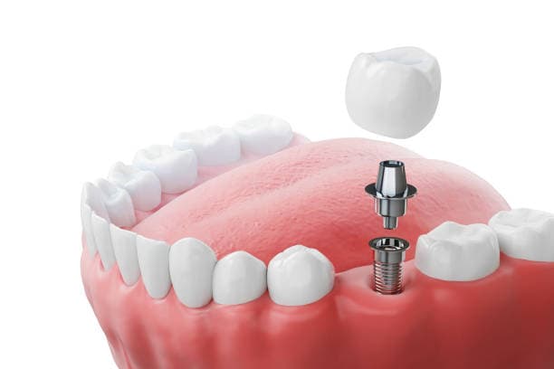 Dental Implants vs. Bridges: What's Right for You?