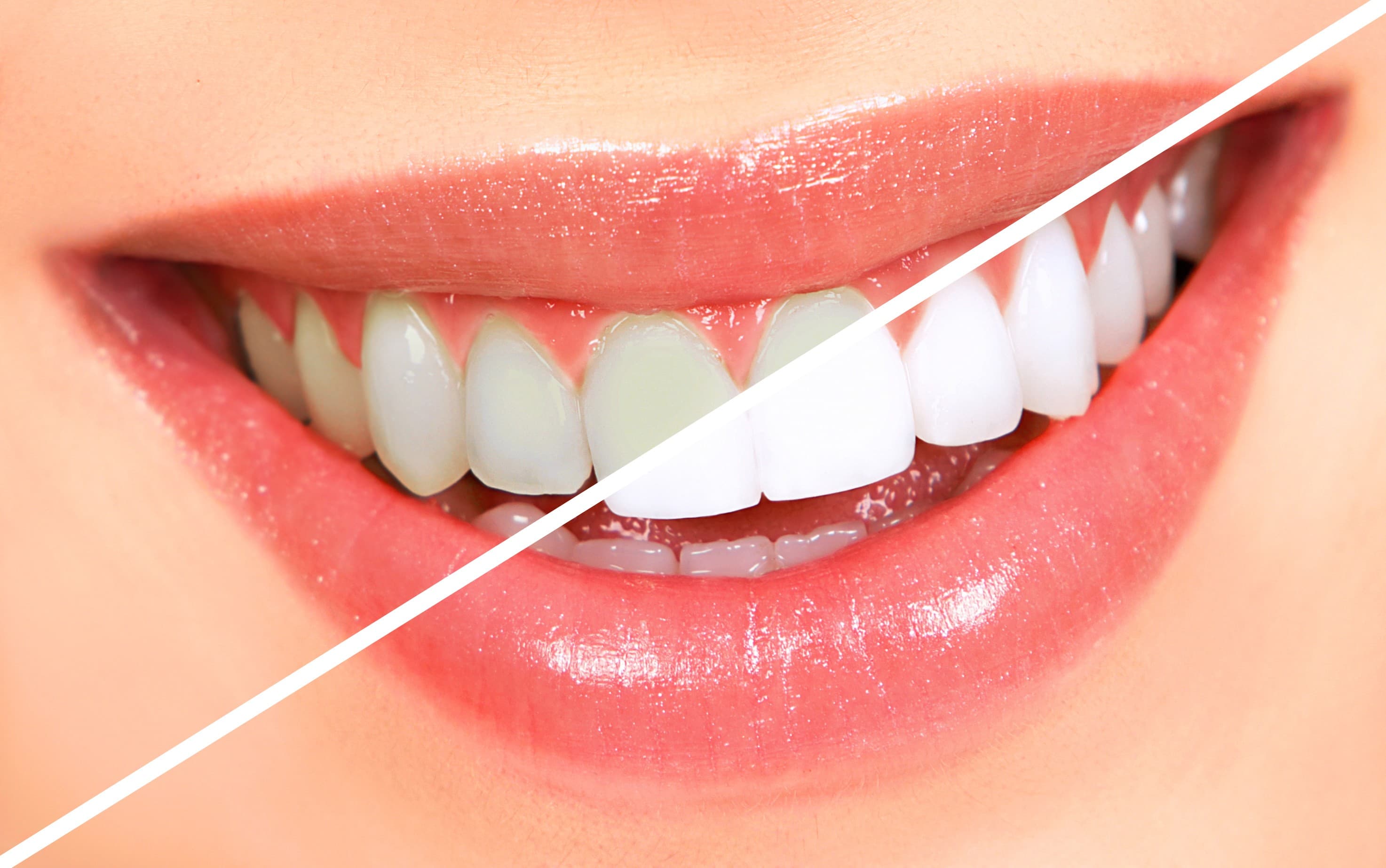 Teeth Whitening: Facts, Myths, and What Really Works